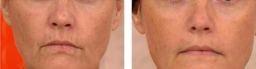 Resultados do tratamento na face